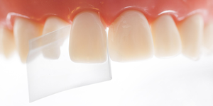 ProxyPal 3D Anterior Matrix (36) (Directa)